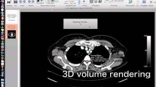 OsiriXsimulated Navigation S1lung segmentectomy [upl. by Llireva]