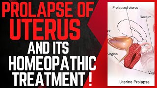 UTERINE PROLAPSE  PROPLASE OF UTERUS  BEST HOMEOPATHIC MEDICINE FOR PROLAPSE OF UTERUS [upl. by Ainimre]