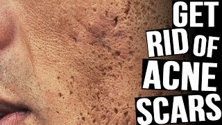 How To Get Rid Of Acne Scars  The BEST Methods [upl. by Misaq]