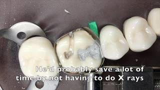 Class 2 amalgam placement demonstration [upl. by Kopp]