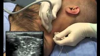 Interscalene Block ultrasound guided  in plane [upl. by Anahsar954]