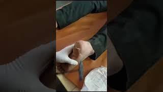 Calcaneal Spur Heel Spur Ayurvedic Treatment Through Agnikarma  वात कंटक [upl. by Felty]