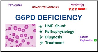 G6PD Deficiency  PathophysiologyClinical FeaturesLab DiagnosisTreatment pathology biochemistry [upl. by Anaihk879]