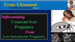 Fetus Ultrasound Differentiating Cesarean Scar Pregnancy from Low Intrauterine Pregnancy [upl. by Leventis]