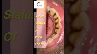 Got Teeth Stains like these Get Professional Teeth Cleaning by dentist today scaling clean [upl. by Lenno]