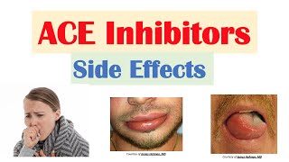 ACE Inhibitor Side Effects Lisinopril Ramipril Captopril Perindopril  Causes and Why They Occur [upl. by Yltsew814]