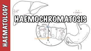 Haemochromatosis Iron Overload  iron physiology causes and pathophysiology [upl. by Esyli]