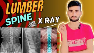 Lumber spine  lumber spine x ray  lumber spine c ray positioning  x ray [upl. by Unhsiv87]