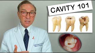 What Causes Tooth Decay Cavity 101  Causes  Treatment [upl. by Eddana]