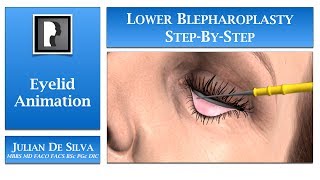 Blepharoplasty Animation – How is Lower Blepharoplasty Eyelid Surgery completed [upl. by Sacken391]