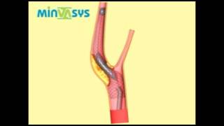 Colocação de Stent de carótida  Angioplastia [upl. by Leandre176]