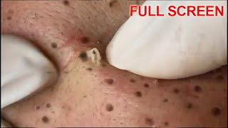 Blackheads Removal  Best Pimple Popping Videos [upl. by Ursuline]