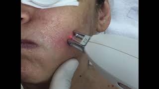 Besenreiser Couperose und Rosacea entfernen mit NdYagLaser [upl. by Ecnar]