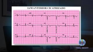 Infarto Agudo no Miocárdio  Diagnostico I 510 [upl. by Lallage]