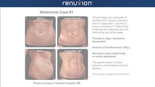 Renuvion Skin Tightening  Before amp After  Premier Liposuction [upl. by Nahtad783]