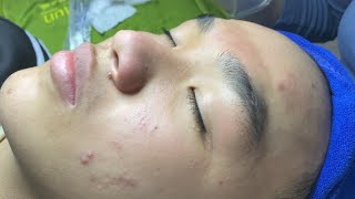 Acne treatment for Spa Linh Mun 2024 13 [upl. by Ntsud320]