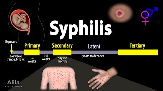 Syphilis  Pathophysiology Diagnosis and Treatments Animation [upl. by Fusuy]