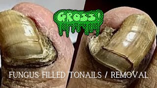 GROSS Unbelievable Sensitive and Thick Nail Cutting  Must See [upl. by Ly795]