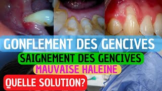 Pourquoi Vos Gencives Saignent  Causes Prévention et Traitement de la Gingivite [upl. by Leksehc]