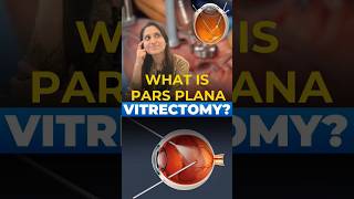 What is Pars Plana Vitrectomy [upl. by Enelrahs]