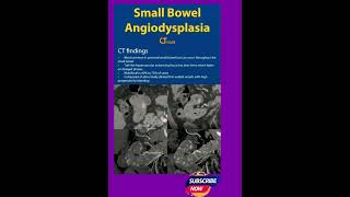 Small Bowel Angiodysplasia  CT  Radiology [upl. by Allys]