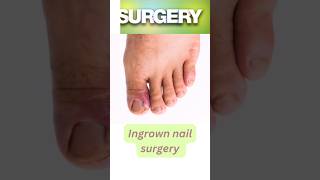 Ingrown Toe Nail Surgery  चमड़ी में धंसे नाखून की सर्जरी ingrownnailclip ingrowntoenailsurgery [upl. by Iman745]