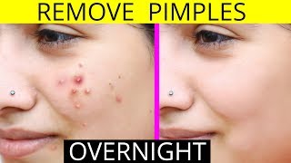 How To Remove Pimples Overnight  Acne Treatment  Anaysa [upl. by Rotceh937]