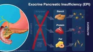 Exocrine Pancreatic Insufficiency [upl. by Nadean]