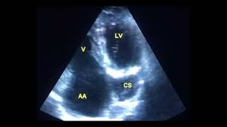 Coronary sinus mimicking a cyst to drahmadmirdamadisikTUfcNTCW7N2iR8 [upl. by Lettie]