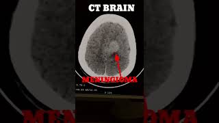 meningioma C T Brain [upl. by Noellyn47]