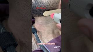 Laser Hair Removal Treatment getsmarthairclub hair viralvideo hairremoval [upl. by Nlycaj91]