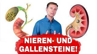 Ursachen von Gallen und Nierensteinen und wie man sie vermeidet  Dr Berg Deutsch [upl. by Ellehcal]