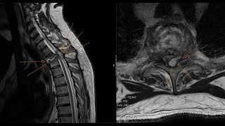 Spinal epidural abscess  spondylodiscitis  insufficiency spinal fracture CT and MRI correlation [upl. by Iand245]