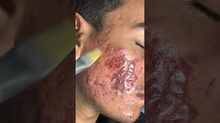 Skinaa Clinic Chemical Peel Treatment Get Smooth and Glowing Skin almost Instantly shorts viral [upl. by Lleryt]