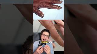 What is dyshidrotic eczema eczema rash doctor [upl. by Jobie]