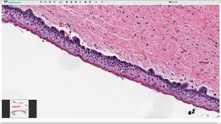 Odontogenic Keratocyst  Histopathology [upl. by Ahsenauq669]