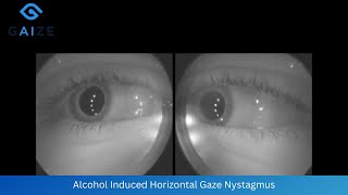 Alcohol Induced Horizontal Gaze Nystagmus at Maximum Deviation [upl. by Goodson]