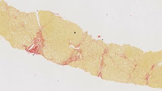 HISTALIM Chronic diseases  Hepatic fibrosis collagen quantification on human liver [upl. by Severin]