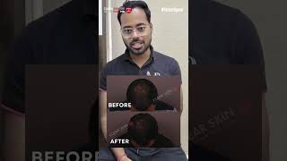 Crown Hair Loss Amazing Results in Just 3 Months  HairMd Clinic Pune [upl. by Zack]