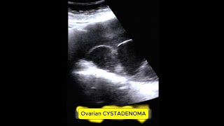 OVARIAN CYST ADENOMA mass infertility ovarian [upl. by Alemat]