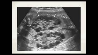 Fetal Dysplastic kidney [upl. by Gristede]