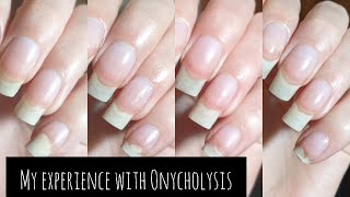 My Experience With Onycholysis  Including Pictures And Advice [upl. by Dodwell15]