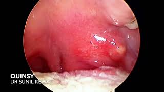 Quinsy  Peritonsillar Abscess  Dr Sunil Kewat [upl. by Culberson152]