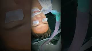 General Anesthesia Patient Views shorts [upl. by Dovev80]