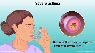 Understanding Asthma Mild Moderate and Severe [upl. by Dnomsad]