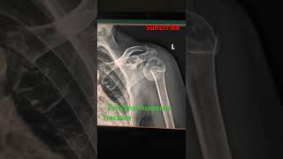 Proximal humerus fracturexray subscribe support ytshorts viralshorts [upl. by Epilihp]