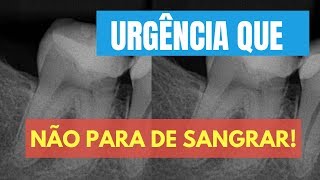 O QUE FAZER EM UMA URGÊNCIA ONDE O CANAL NÃO PARA DE SANGRAR  QUICK TIP ENDOLOVERS [upl. by Suirtemid]