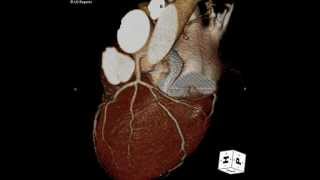 UCSF Radiology A Rotational View of the Heart and Coronary Arteries [upl. by Yelhs669]