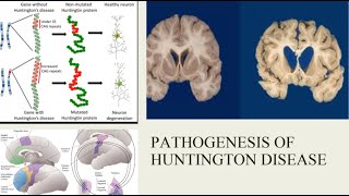 Huntington’s Disease Our Current Understanding of Its Pathophysiology and Genetics [upl. by Llehcsreh]