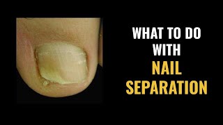 NAIL SEPARATION  What to DO and What are the CAUSES [upl. by Ykciv]